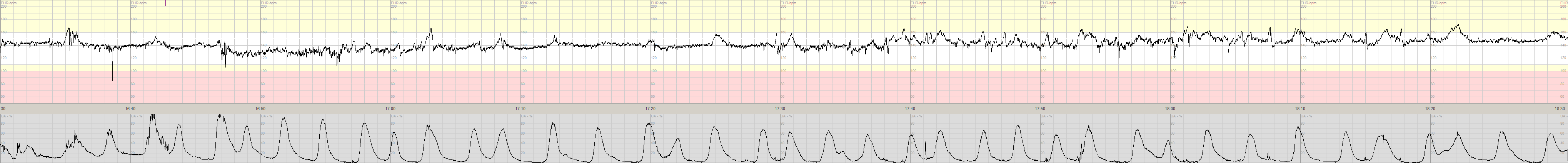 3 2 1 normal CTG registrering